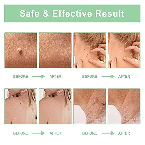 DINHAND Skin Tag Remover, Micro Skin Tag Removal Kit for Small to Medium (2mm...