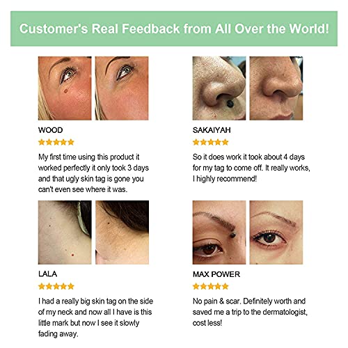 DINHAND Skin Tag Remover, Micro Skin Tag Removal Kit for Small to Medium (2mm...