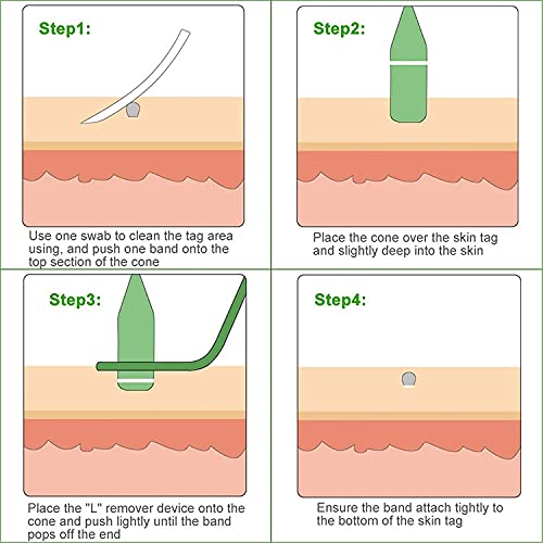 DINHAND Skin Tag Remover, Micro Skin Tag Removal Kit for Small to Medium (2mm...