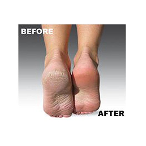 Extra Coarse Pedicure Refill Rollers Compatible With Amope Pedi Perfect Elect...