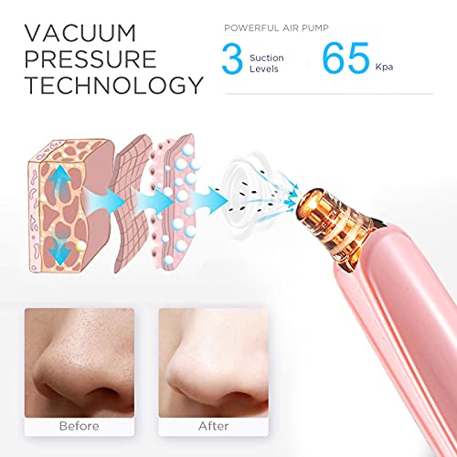 Blackhead Remover Pore Vacuum Cleaner - Upgraded Facial Pore Cleaner - Electr...