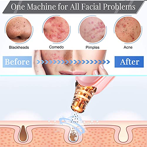 Blackhead Remover Pore Vacuum Cleaner - Upgraded Facial Pore Cleaner - Electr...