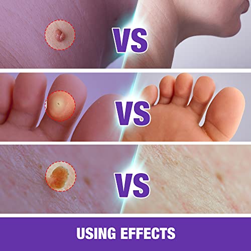 2×Extra Strength Skin Tag Remover Mask, Skin Tag Removal Mask, Exclusive Form...