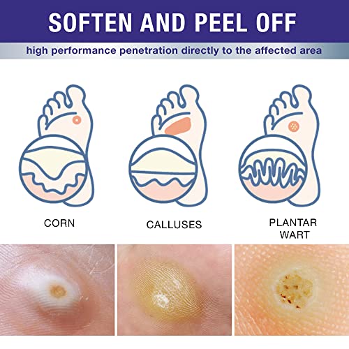 Exclusive Formula Liquid Corn & Wart Remover Mask, Wart Removal Mask, Fast-ac...