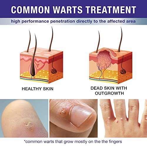 Exclusive Formula Liquid Corn & Wart Remover Mask, Wart Removal Mask, Fast-ac...
