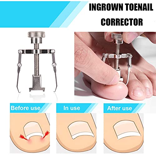 Ingrown Toenail Tool Kit (9PCS), Professional Toe Nail Clipper Set for Ingrow...