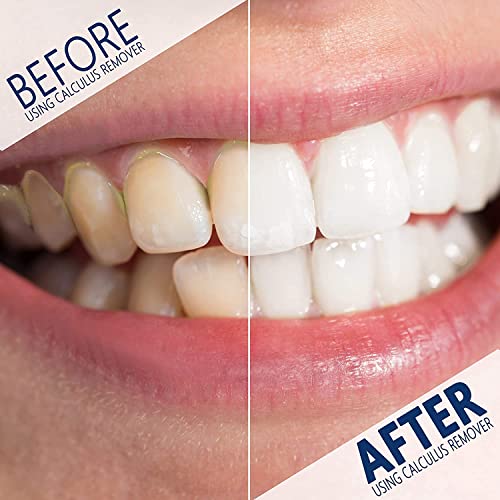 Plaque Remover For Teeth Cleaning Kit - Gum Stimulator - Dental Calculus Remo...