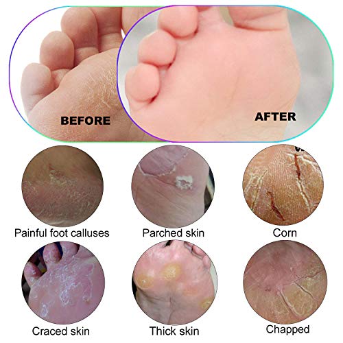 Foot Scrubber Callus Remover for Feet - Ejiubas Foot Scraper Pedicure Foot Fi...