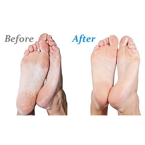 Emjoi Micro-Pedi 3D POWER Callus Remover with Xtreme Coarse Soft & Flexible R...