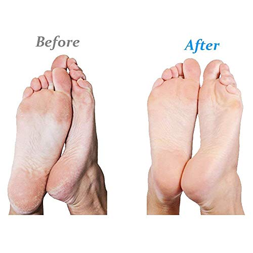 Emjoi Micro-Pedi Callus Remover