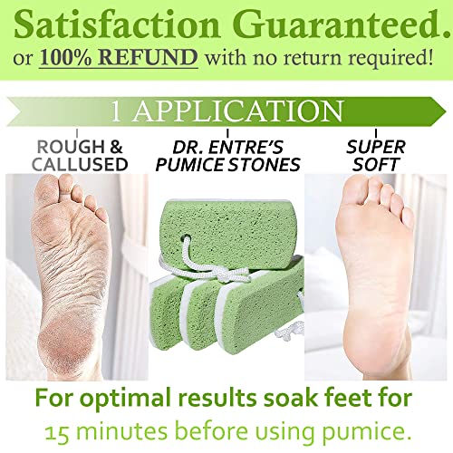 Dr. Entre's Pumice Stone for Feet 4 Pack: Callus Remover, Dead Skin Scraper, ...