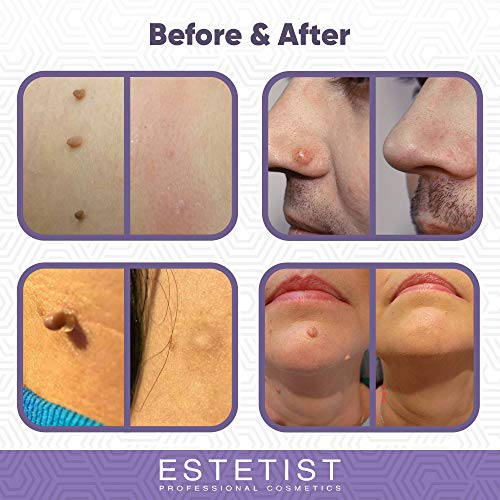 New Formula, Skin Tag Remover Patches, Wart and Acne Remover Patches, Pimple ...