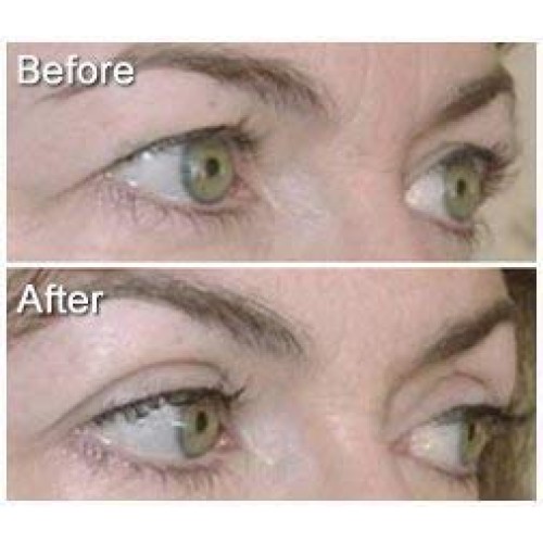 Eye Magic Original Eye Lift Kit (Small/Medium)