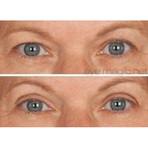 Eye Magic Original Eye Lift Kit (Small/Medium)