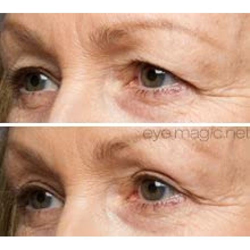 Eye Magic Original Eye Lift Kit (Small/Medium)