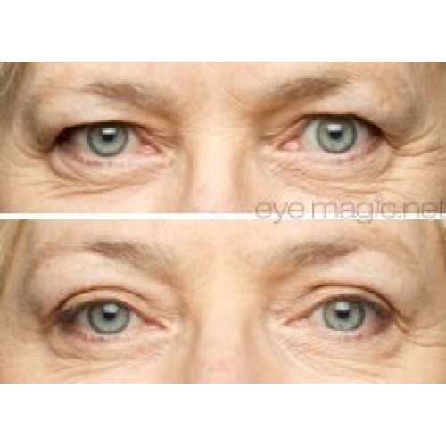 Eye Magic Original Eye Lift Kit (Small/Medium)