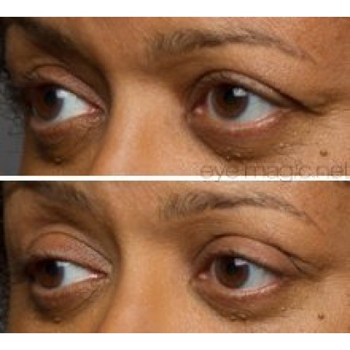 Eye Magic Original Eye Lift Kit (Small/Medium)