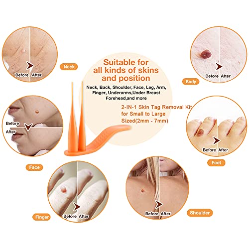 2022 Skin Tag Removal Mole Kit, 2-in-1 Skin Tags & Moles Remover Patches, Bod...