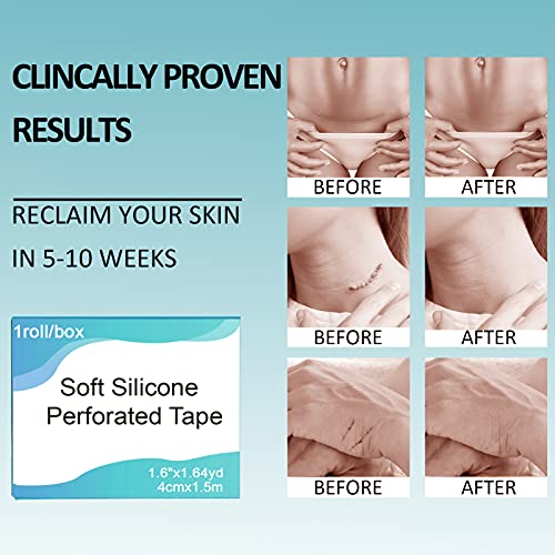 Fanhostco Medical Silicone Scar Tape (1.6” x 60”) - Silicone Strips Gel Tape ...