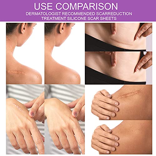 Silicone Scar Tape Roll, 1.6” x 60” Medical Tape for Wound Care Bandages Scar...