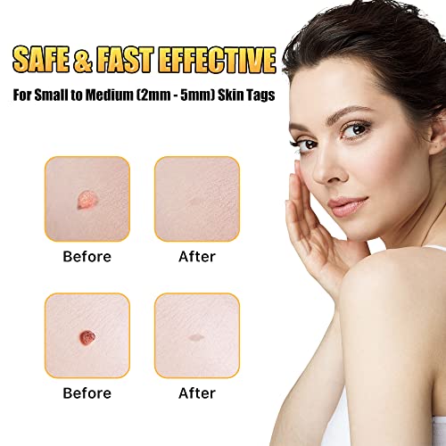 Skin Tag Remover, Micro Skin Tag Removal Kit for Face, Neck, Finger and Body,...