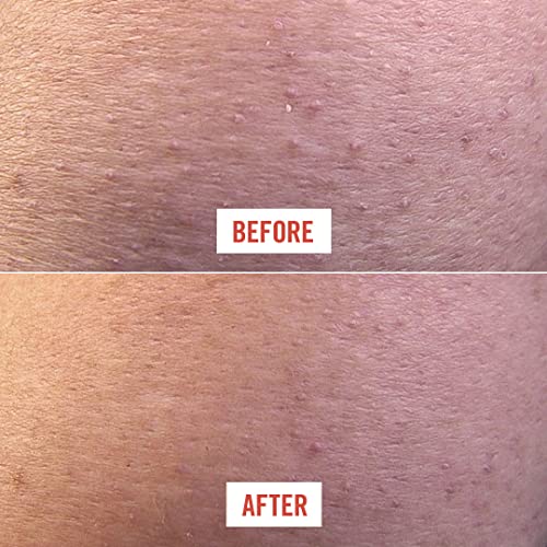 First Aid Beauty KP Bump Eraser Body Scrub Exfoliant for Keratosis Pilaris wi...