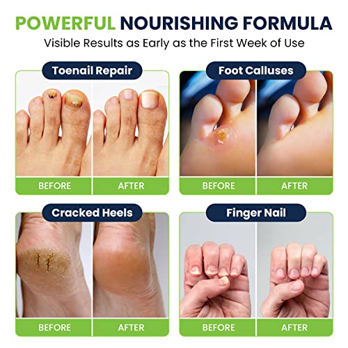 Foot Cure 3-in-1 Professional Foot Spa Kit - Tea Tree Foot Soak With Epsom Sa...