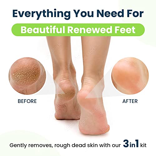 Foot Cure Callus Remover Kit for Feet - Professional Extra Strength Callus Re...