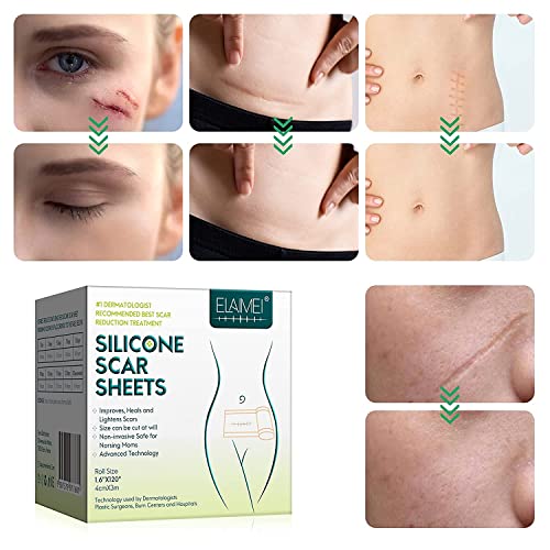 Silicone Scar Sheets (1.6” x 120”), Medical Grade Silicone Scar Tape Roll, Su...