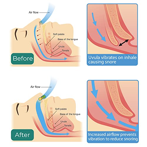 Glalove Anti-Snoring Solution, 4 Pack Silicone Magnetic Nose Clips & 8 Pack S...
