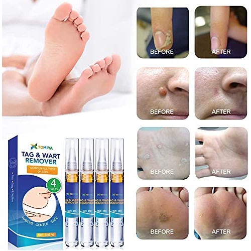 Skin Tag Removal, Tag Remover Pen for Skin Care Product Men and Women (4 Packs)
