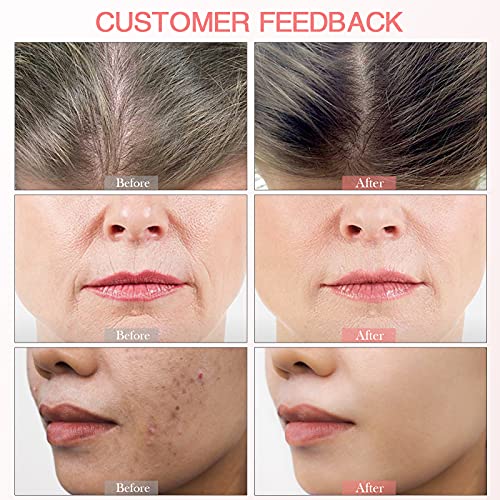 Microneedle Derma Roller for Face Skin Body and Hair Growth, Facial Dermaroll...