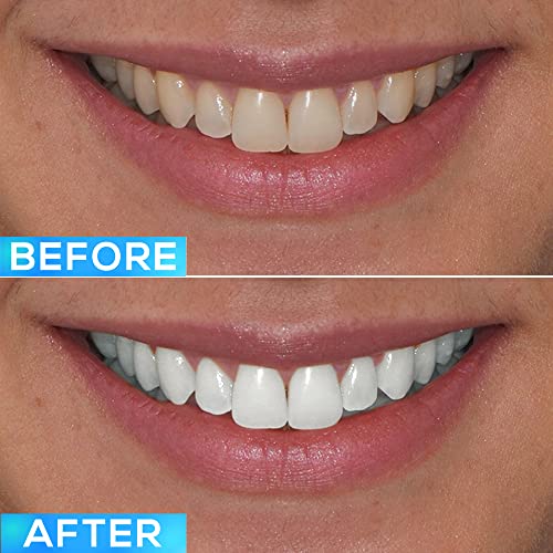 GLO Brilliant Personal Teeth Whitening Device