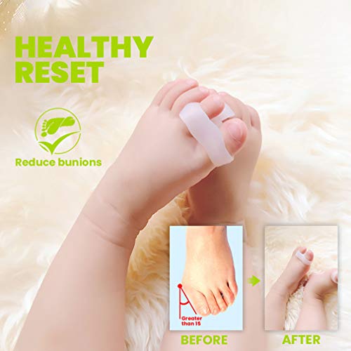 GloDeals Bunion Corrector, 6pcs Kids toe separator Soft Gel Bunion Pad&Spacer...