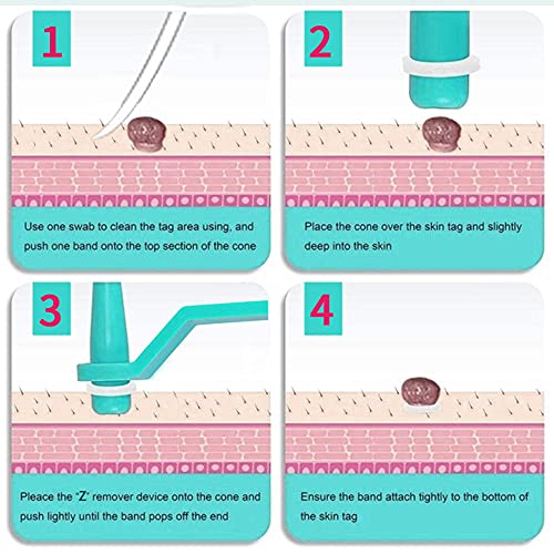 77PCS Skin Tag Remover for 2-5mm Skin Tag, Skin Tag Remover Patches, Face Car...