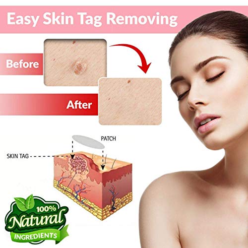 Skin Tag Remover Patch Maximum Strength 72 Pcs, Skin Tag and Acne Remover Pat...