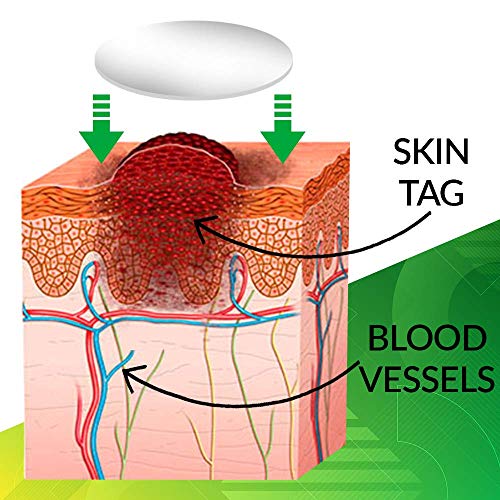 Skin Tag Remover Patch Maximum Strength 72 Pcs, Skin Tag and Acne Remover Pat...