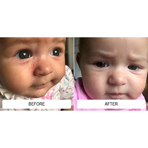 Dr. Eddie’s Happy Cappy Medicated Shampoo for Children, Treats Dandruff and S...