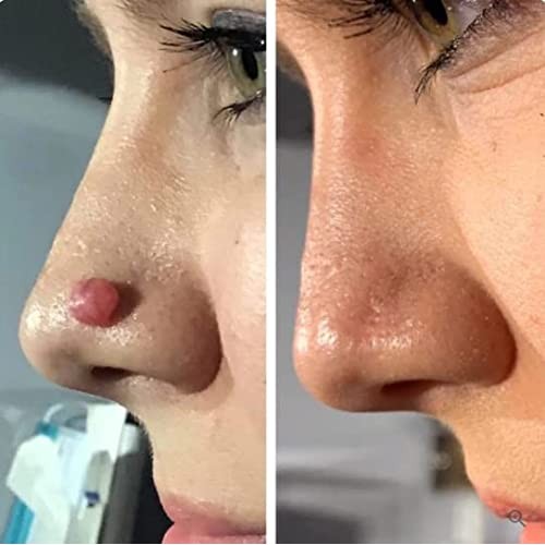 Hawtrytoa WartsOff Instant Blemish Removal Set, Skin Tag Remover & Wart Remov...