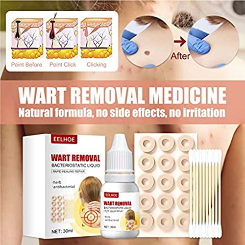 Hawtrytoa WartsOff Instant Blemish Removal Set, Skin Tag Remover & Wart Remov...