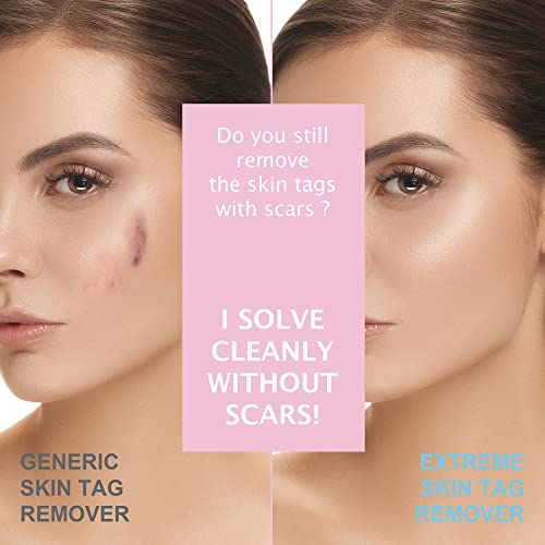 Skin Tag Remover, Warts & Mole Remover Cream- Quickly and Easily Remove Commo...