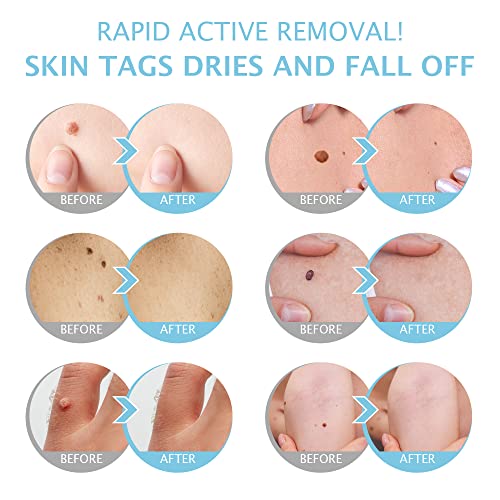 Skin Tag Remover, Warts & Mole Remover Cream- Quickly and Easily Remove Commo...