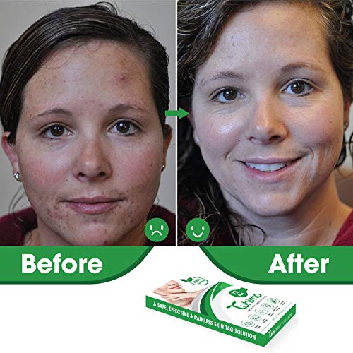 TUHIMO Skin Tag Remover Patches, Acne Remover for Medium to Large Skin Tags, ...