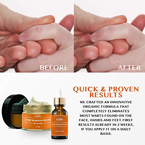Wart & Skin Tag Remover Set Essence + Cream Lotion Effective Treatment Wart R...
