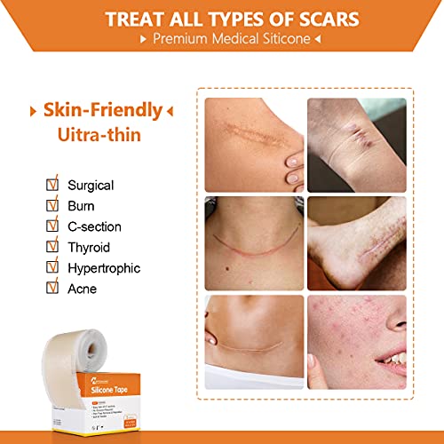 Medical Grade Soft Silicone Scar Tape, Keloid Scar Removal Treatment. Scar Pa...