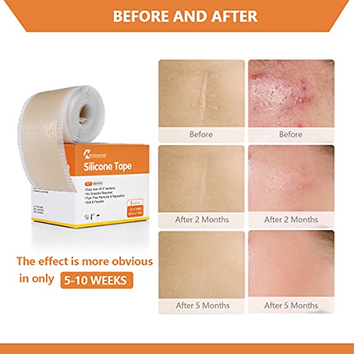 Medical Grade Soft Silicone Scar Tape, Keloid Scar Removal Treatment. Scar Pa...
