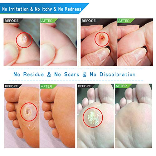 Corn Remover for Feet, Removes Callus, Toe Corns Fast, While Giving you Treat...