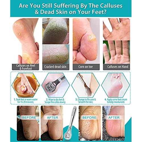 15Pcs Callus Shaver, Callus Remover for Feet, Heel Hard Skin, Corn Callous Re...