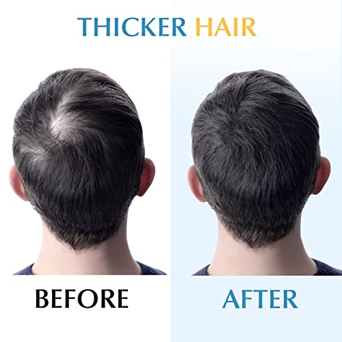 Derma Roller Microneedle Micro Dermaroller: Needle Facial Microneedling Needl...