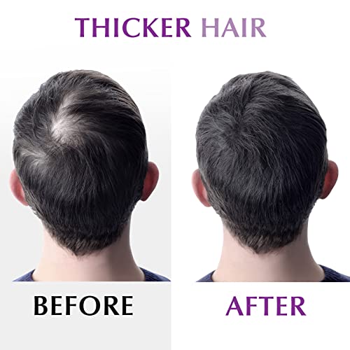 Derma Roller Skin Dermaroller Microneedle: Skin Rollers Micro Needle Kit 0.25...